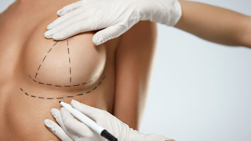 blizny-po-powiekszaniu-piersi-chirurgia
