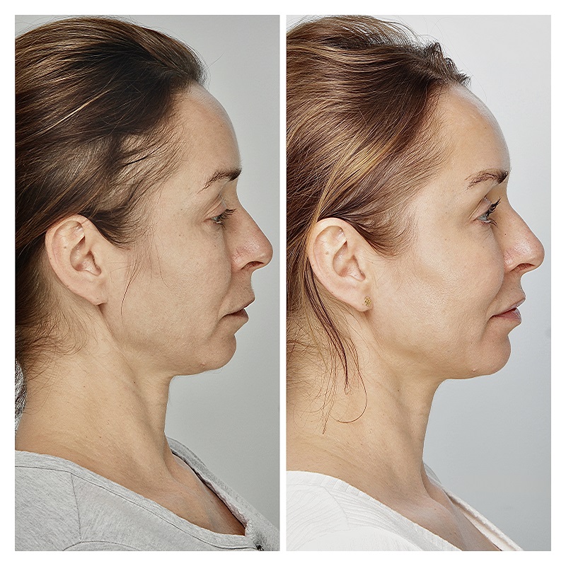 Modelowanie i regeneracja twarzy własnym tłuszczem