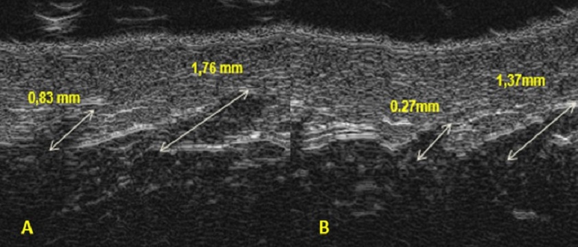 USG w zabiegach na ciało