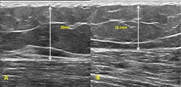 USG w zabiegach na ciało
