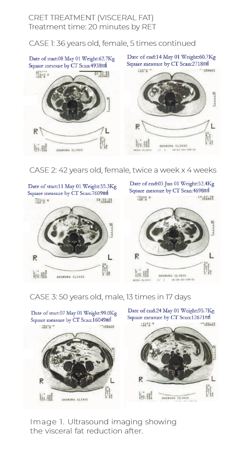 Obrazowanie CT przedstawiające redukcję tłuszczu trzewnego u pacjentów po serii terapii RET (448 kHz) – porównanie przed i po leczeniu.